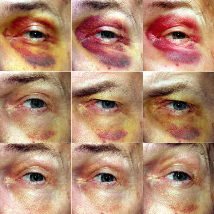 Symbolbild Blaues Auge